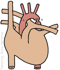 Coarctatie van de aorta