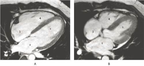 MRI-scan